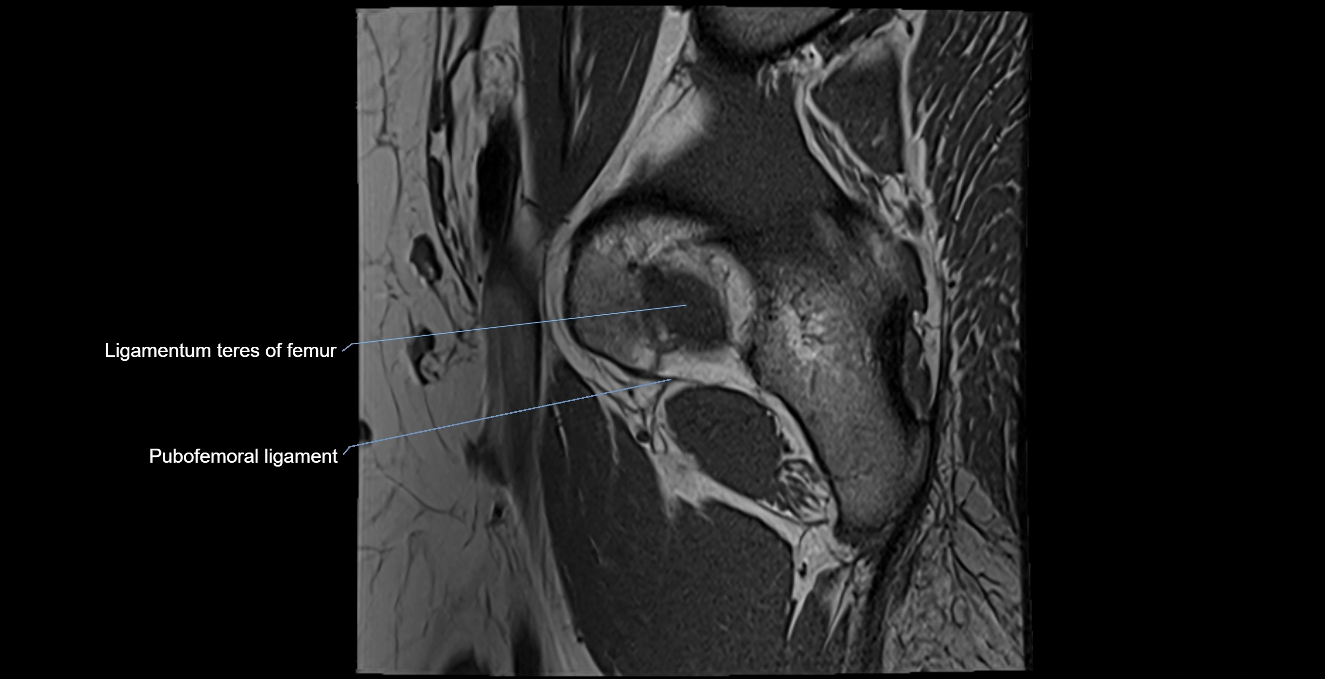 MRI Hip ligaments sagittal cross sectional anatomy 3T  radiology  image-img-00001-00002.webp